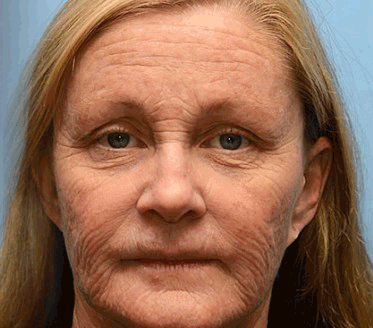 🌹Made and shipped from the CA 💫Rolimey® Botox & Vita-A Retinol Shot Wrinkle-Lift Tightening cream - Last Day Promotion 70% OFF